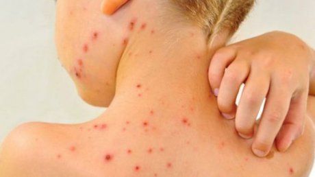 16 noi cazuri de rujeolă în Neamț, în această săptămână