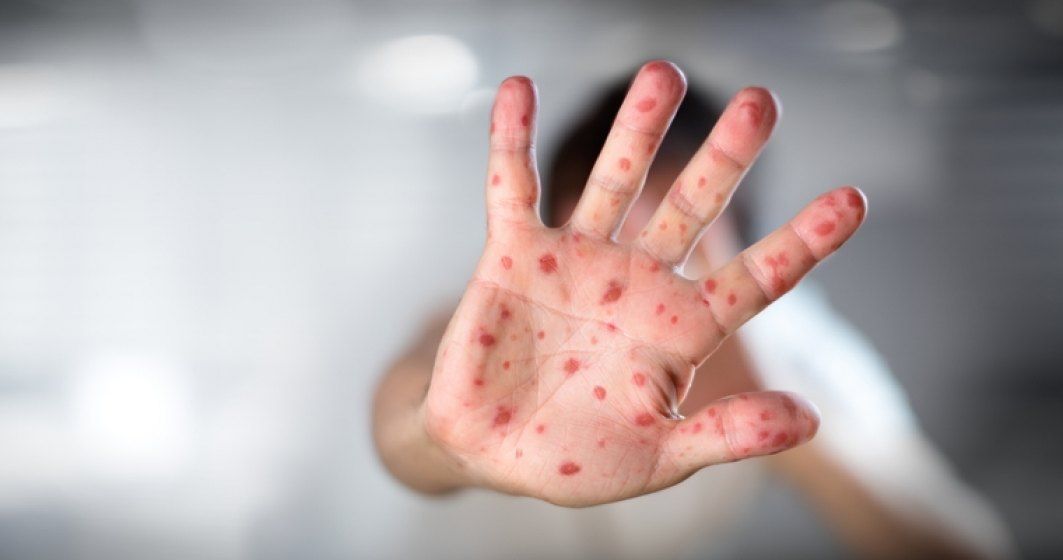 Șase noi cazuri de rujeolă au fost raportate în ultima săptămână